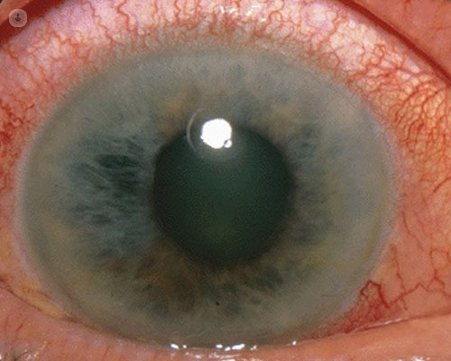 glaucoma-ojo